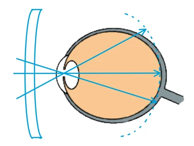 b) Korrektur der Kurzsichtigkeit mit  Einstärkengläsern