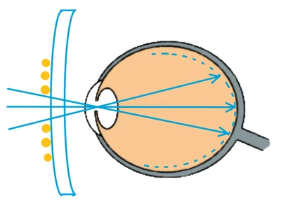 c) Korrektur mit MiYOSMART-Gläser