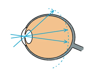 a) Unkorrigierte Kurzsichtigkeit